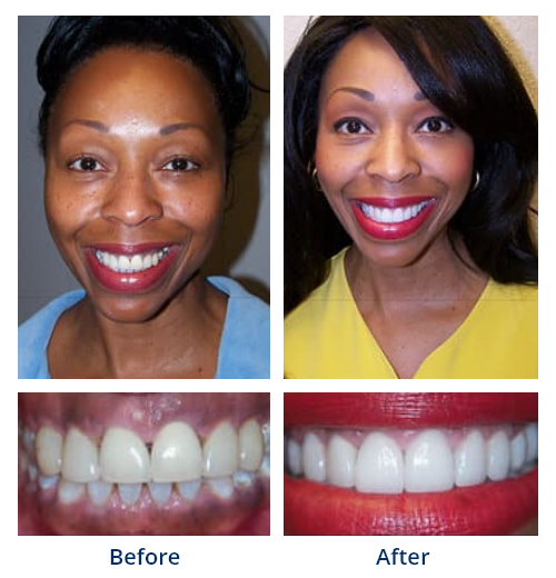 Before-and-after smile gallery case 6
