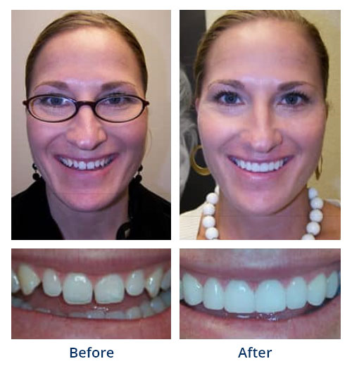 Before-and-after smile gallery case 4