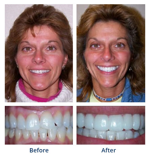 Before-and-after smile gallery case 3