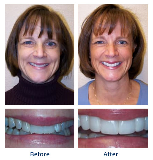 Before-and-after smile gallery case 1