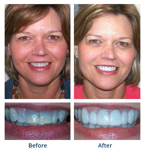 Before-and-after smile gallery case 5